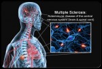 Множествена склероза - МС